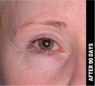 Ultherapy Before & After Patient #1547